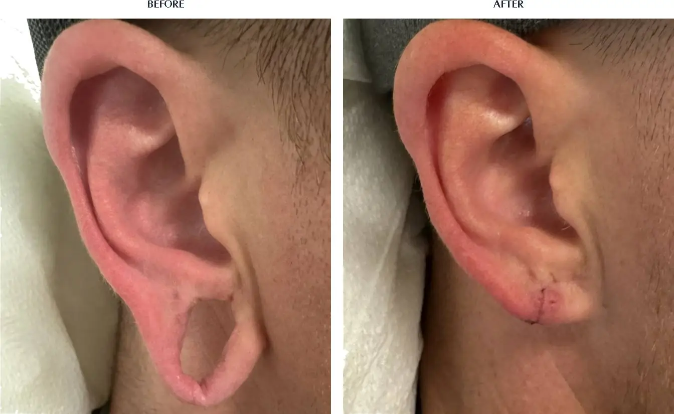 Patient 794 Earlobe Repair