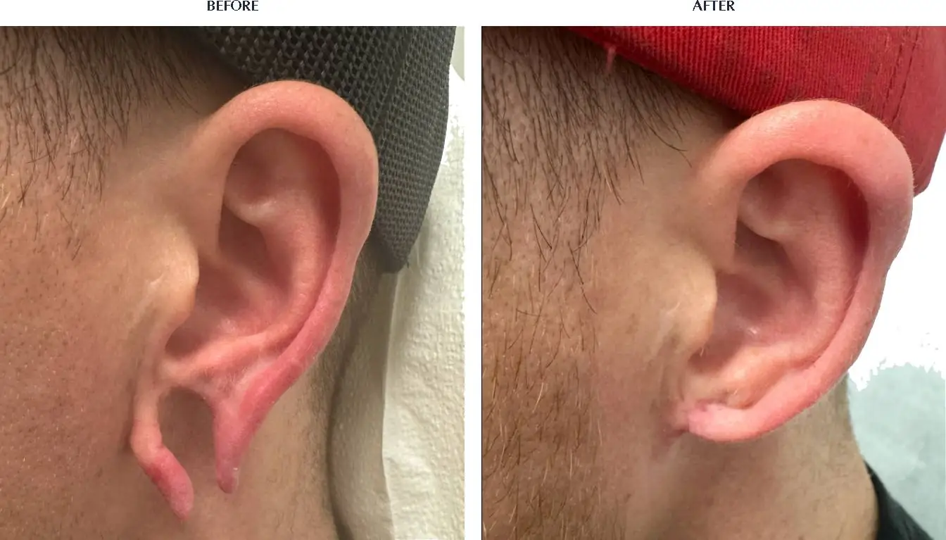 Patient 796 Earlobe Repair